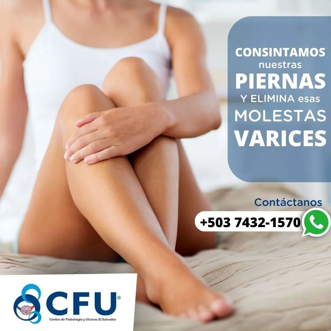 Tratamiento Para Varices En San Salvador
